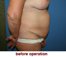 plastic-surgery-tummy-tuck